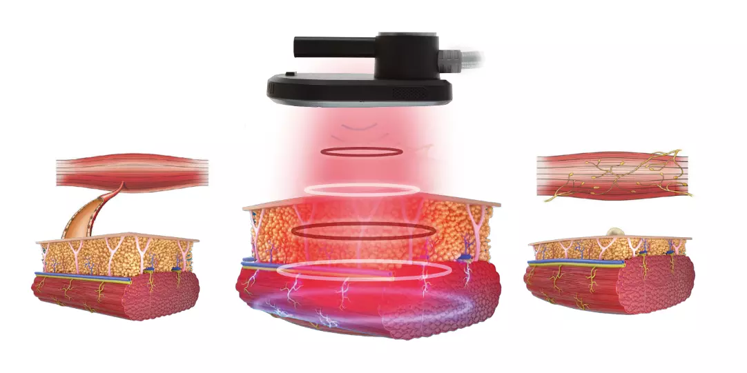 EM-Contouring RF Machine