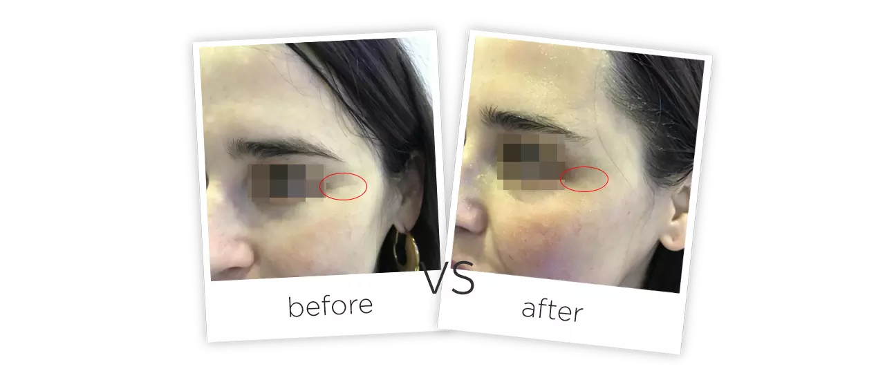 Eliminar las Arrugas & Apretar Representación