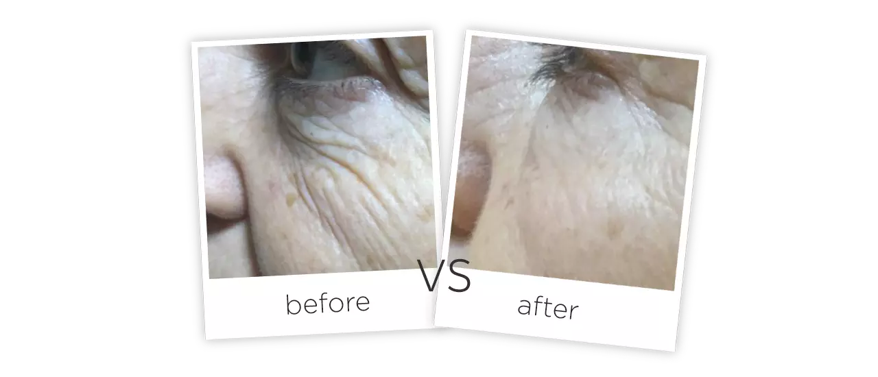 Eliminar las Arrugas & Apretar Antes y despues