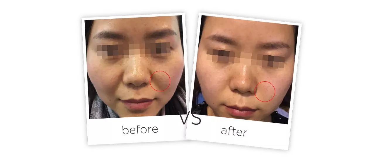 La Máquina HIFU de Belleza para Levantaminto Facial Representación
