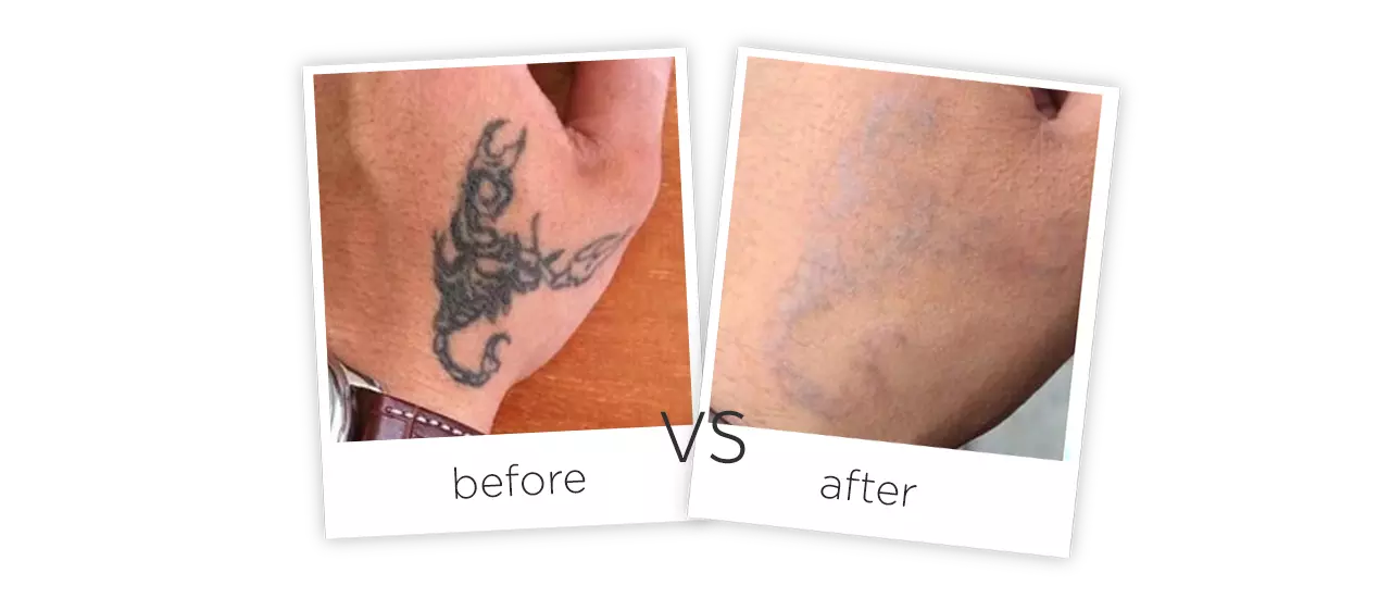 Picosegundo Láser Tatuajes de Eliminacion Antes y despues