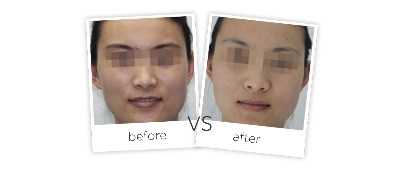 Cuidado Dario Facial Antes y despues