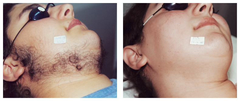 depilacion laser antes y despues mujeres