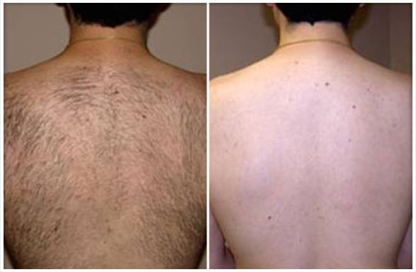 depilacion laser antes y despues hombres