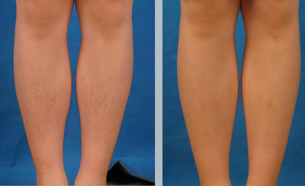 depilacion laser antes y despues piernas